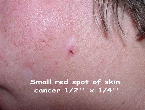 skin cancer cancer black spots  skin