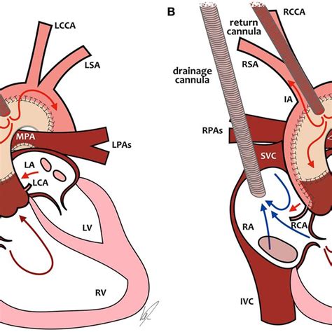 ecmo cannulation  preferential ecmo flows  single ventricle