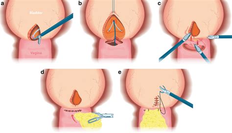 Urinary Fistulas Abdominal Key
