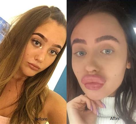 lip filler goes wrong woman forced to hide her baboon s bum pout