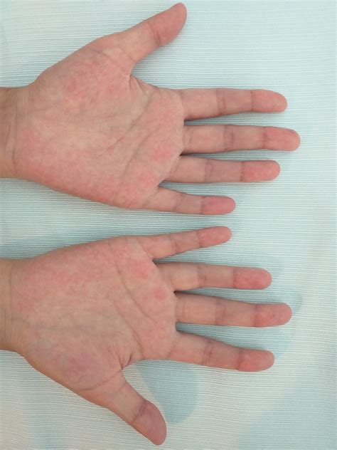 liver palms palmar erythema clinical diagnosis grepmed