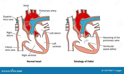 congenital heart defect stock vector illustration