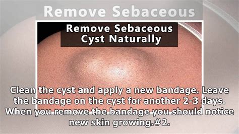 best home remedies for sebaceous cysts youtube