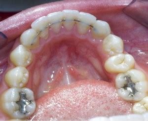types  retainers invisalign austin dentist