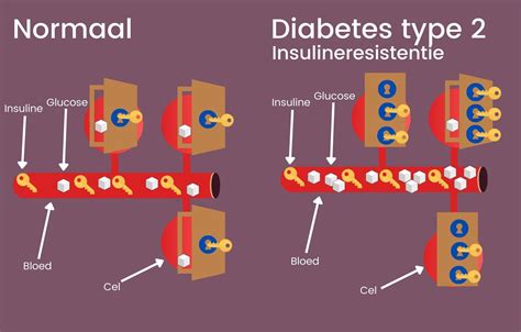 wat  diabetes en insuline resistentie
