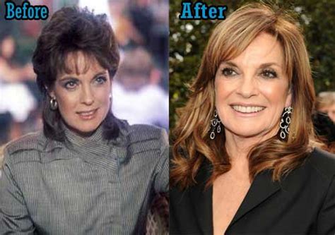 How Old Is Linda Gray Plastic Surgery Before And After