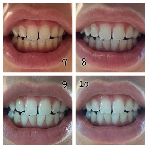 opalescence    home teeth whitening system bellyrubz beauty