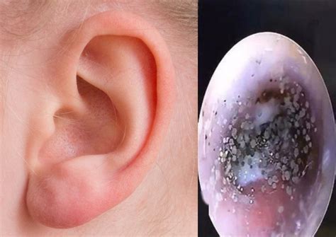 mould  growing  boys ear canal    due  wearing earphones