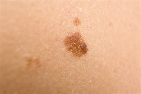 brown spots  skin prevention treatment  home remedies