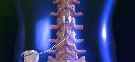 global spinal cord stimulation devices market    boston