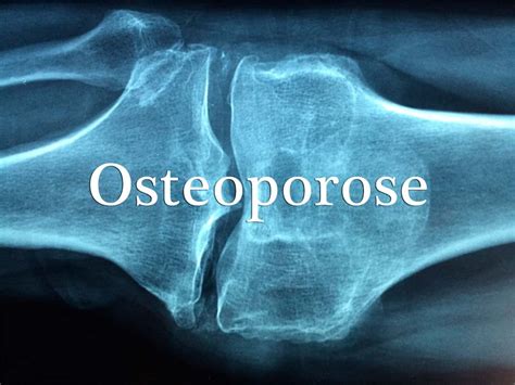 osteoporose grupo escolar