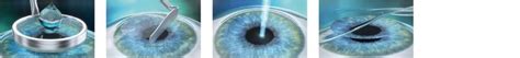 lasek prk ooglaseren informatie  lasek ogen laseren