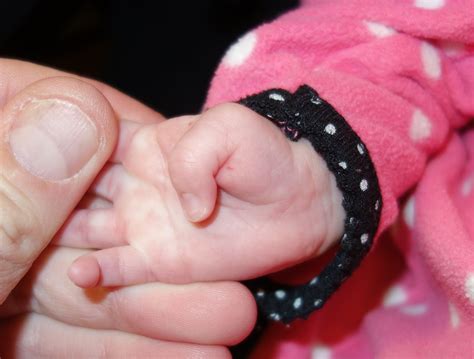 clasped thumb congenital hand  arm differences