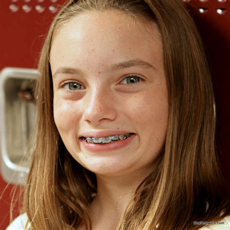 60 photos of teenagers with braces oral answers