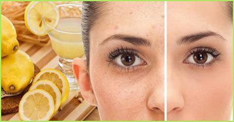 12 home remedies to get rid of freckle on face