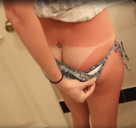 her worst sunburn porno fotos eporner