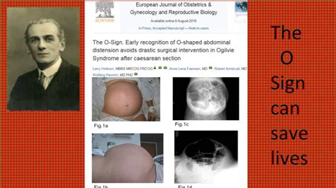 sign  ogilvie syndrome  cesarean section youtube