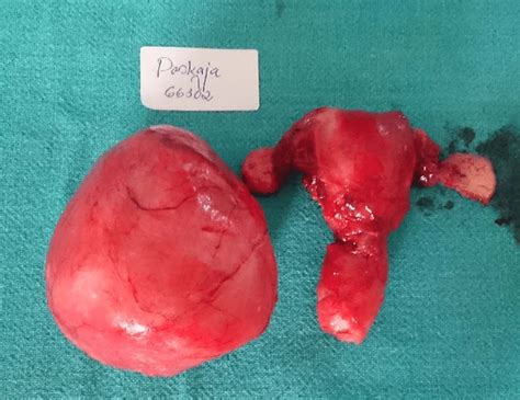 Gross Operative Specimen Of Uterus Cervix Ovaries And Broad Ligament