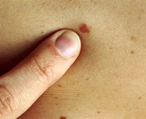 skin cancer pictures