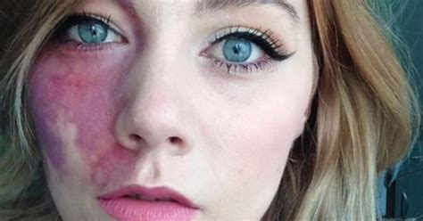 woman told she was too ugly to love and undateable proudly shows facial birthmark she s