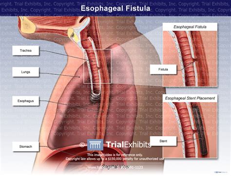 Esophageal Fistula Trialexhibits Inc