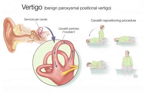 train clients  vertigo exercises repke fitness