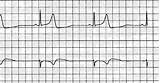 Bradycardia Sinus Ecg sketch template