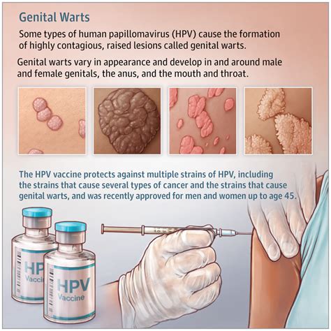 genital warts dermatology jama jama network