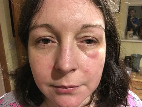 swelling eye swollen eyes punch   face hashimotos disease
