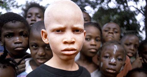 10 tragic facts about albino hunting in africa listverse