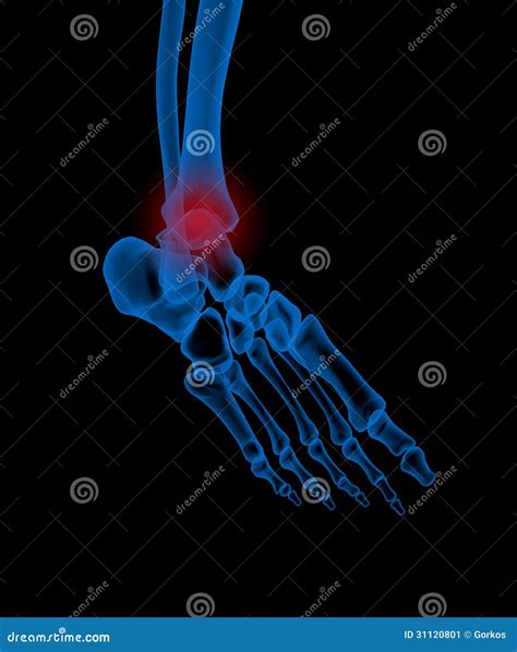 ankle stock image image  balck bones painfull pain