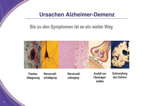 alzheimer demenz powerpoint    id