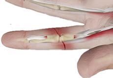 general orthopedics raleigh nc tendon injuries cary apex