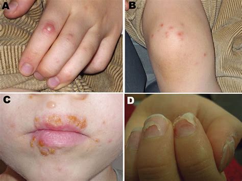 Figure 1 Coxsackievirus A6 And Hand Foot And Mouth