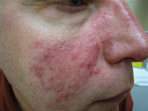 facial redness and pimples rosacea acne and rosacea society