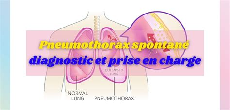 Pneumothorax Spontané Diagnostic Et Prise En Charge Infirmier Pro