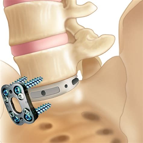 Anterior Lumbar Interbody Fusion Surgery Globus Medical