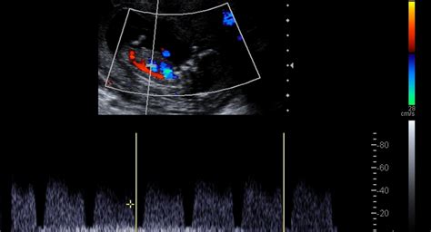 doppler ultrasound scans  pregnancy babycenter india