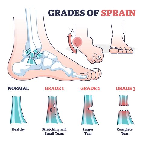 irving ankle strains coppell ankle strains carrollton ankle strains