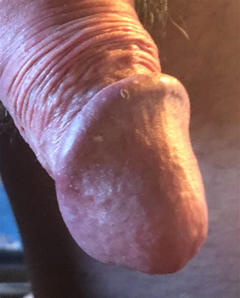 my foreskin pulled back 15 pics xhamster