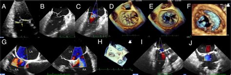 Diagnosis Of Cleft Mitral Valve Using Real Time 3 Dimensional