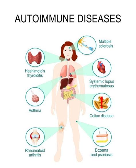 Immune System Diseases Types Symptoms Prevention Std