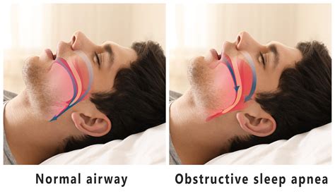 sleep apnea  snoring treatment epic dental