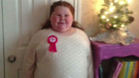 Obese Girl Denied Weight Loss Surgery For Rare Illness Latest News