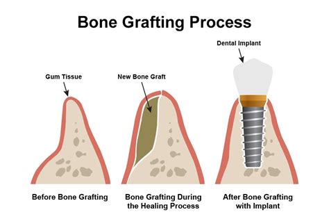 candidate   dental bone grafting lincoln ne