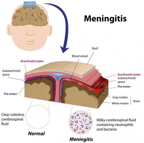 meningitis types causes symptoms treatment measures and prognosis