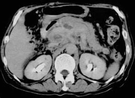 Pt With Retroperitoneal Lymph Node Involvement In The Delayed Phase
