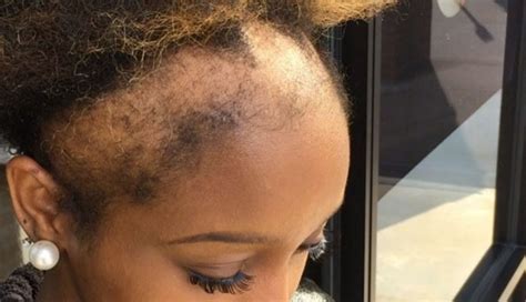 this woman s honesty about her hair loss will make you think twice