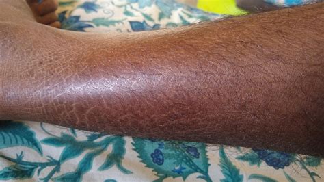 skin concerns    fix  cracks   legs dry skin dont follow  skin care routine