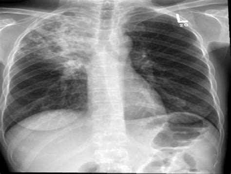 Chest X‑ray Showing Right Upper Lobe Consolidation And Cavitation